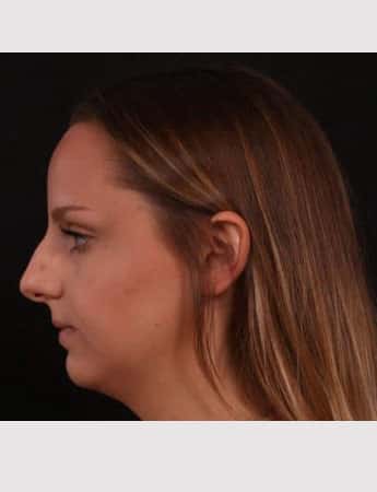 Before Image: Rhinoplasty - left-side