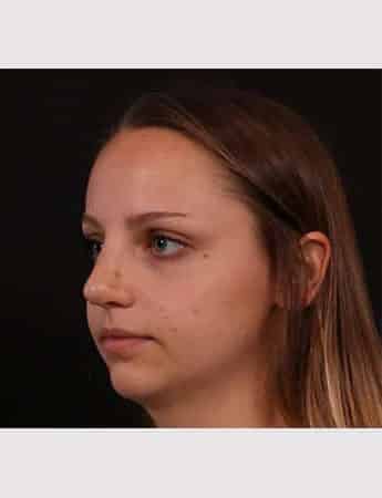 After Image: Rhinoplasty - left-front-oblique