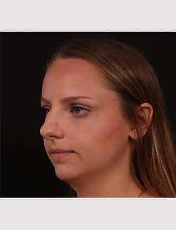 Before Image: Rhinoplasty - left-front-oblique