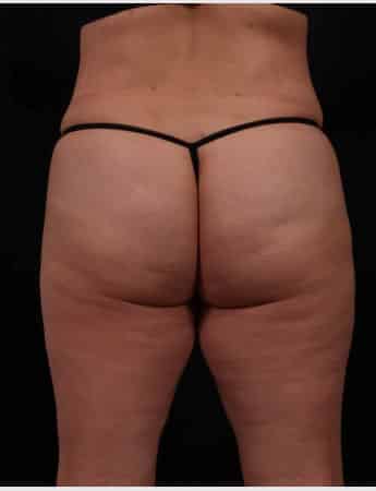 After Image: Liposuction - back