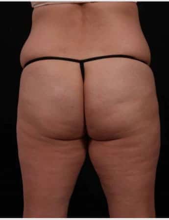 Before Image: Liposuction - back