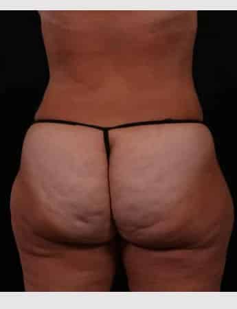 After Image: Liposuction - back