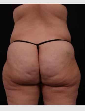 Before Image: Liposuction - back