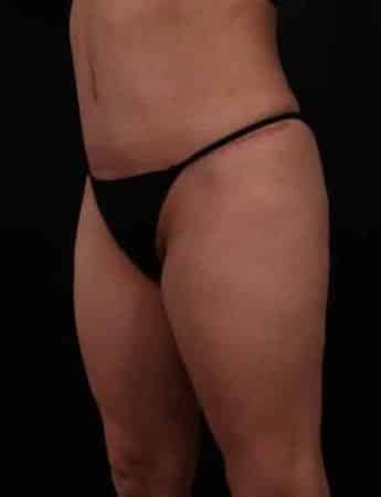 After Image: Tummy Tuck (Abdominoplasty) - left-front-oblique