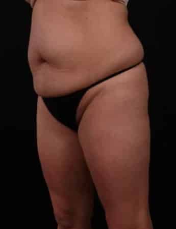 Before Image: Tummy Tuck (Abdominoplasty) - left-front-oblique