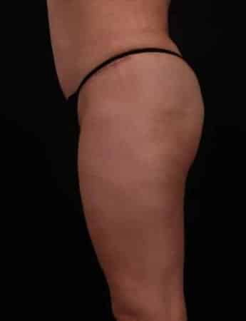 After Image: Tummy Tuck (Abdominoplasty) - left-side