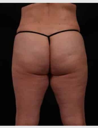 After Image: Tummy Tuck (Abdominoplasty) -
