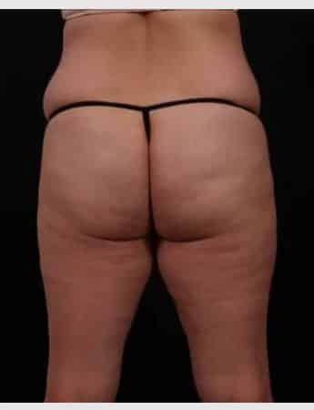 Before Image: Tummy Tuck (Abdominoplasty) -