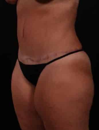 After Image: Tummy Tuck (Abdominoplasty) - left-front-oblique