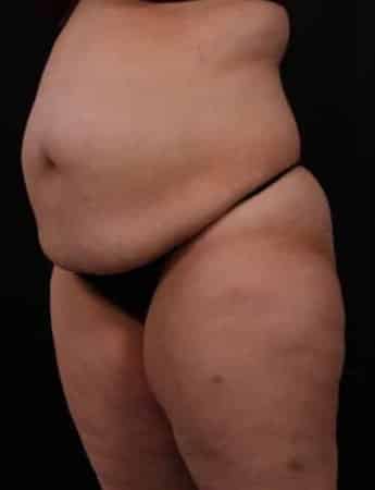 Before Image: Tummy Tuck (Abdominoplasty) - left-front-oblique