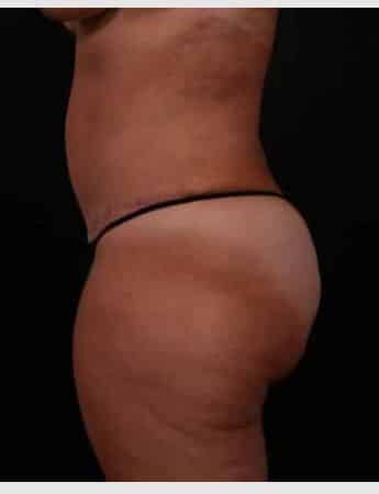 After Image: Tummy Tuck (Abdominoplasty) - left-side