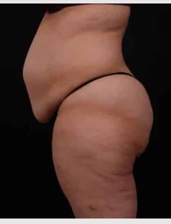 Before Image: Tummy Tuck (Abdominoplasty) - left-side