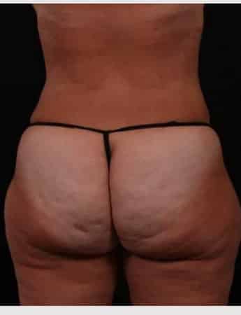 After Image: Tummy Tuck (Abdominoplasty) - back