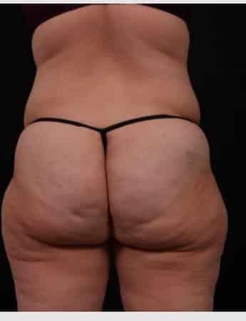 Before Image: Tummy Tuck (Abdominoplasty) - back