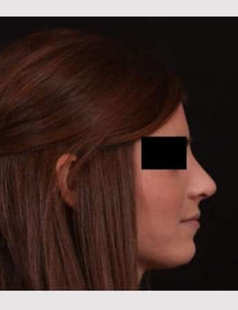 After Image: Rhinoplasty - right-side