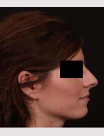Before Image: Rhinoplasty - right-side