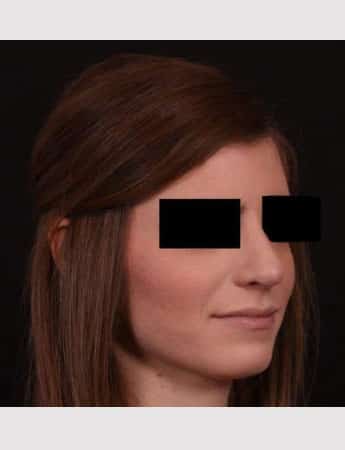 After Image: Rhinoplasty - right-front-oblique