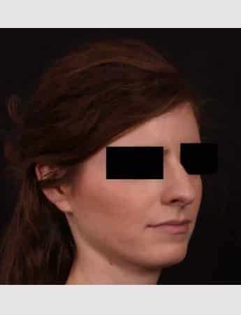 Before Image: Rhinoplasty - right-front-oblique
