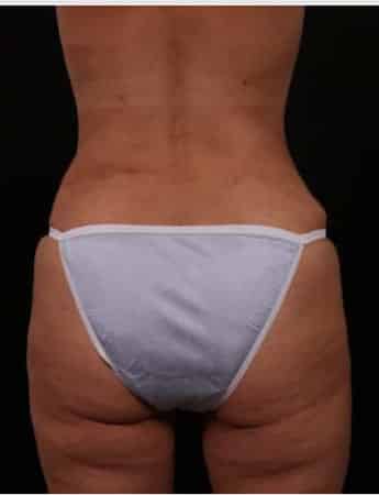 After Image: Liposuction - back
