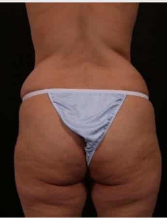 Before Image: Liposuction - back