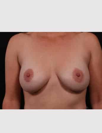After Image: Secondary Breast Surgery - front
