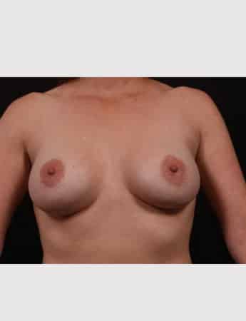 Before Image: Secondary Breast Surgery - front