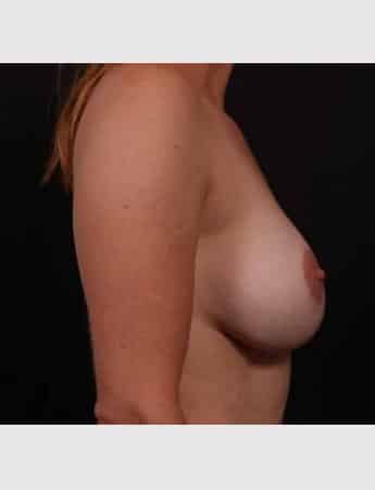 After Image: Secondary Breast Surgery - right-side