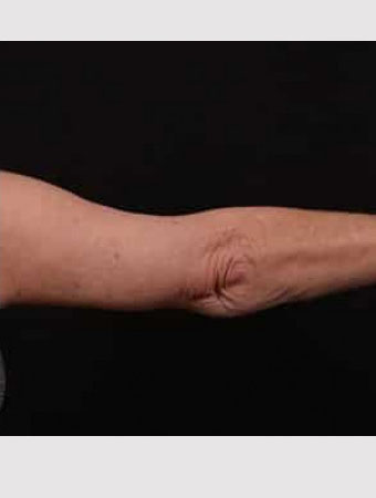 After Image: Brachioplasty (Arm Lift) - back