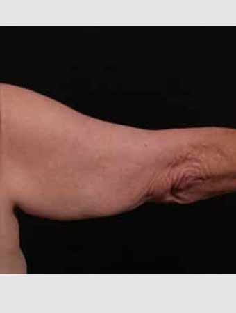 Before Image: Brachioplasty (Arm Lift) - back