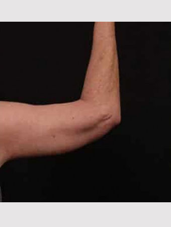 After Image: Brachioplasty (Arm Lift) - back