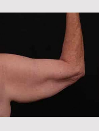 Before Image: Brachioplasty (Arm Lift) - back
