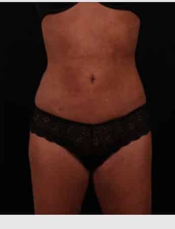 After Image: Liposuction - front