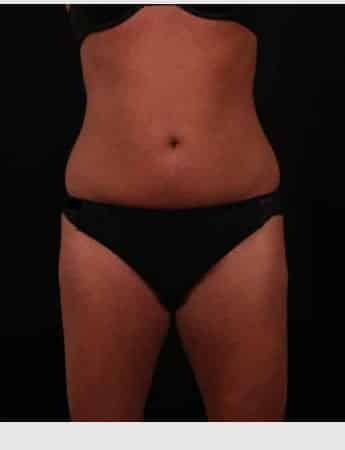 Before Image: Liposuction - front