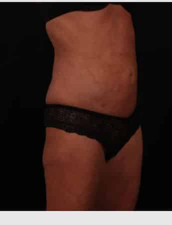 After Image: Liposuction - right-front-oblique