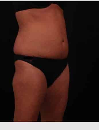 Before Image: Liposuction - right-front-oblique