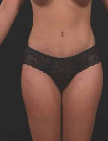 After Image: Tummy Tuck (Abdominoplasty) - front