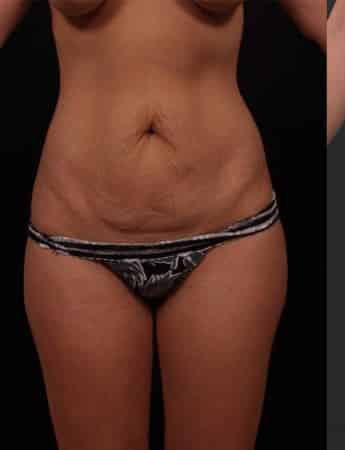 Before Image: Tummy Tuck (Abdominoplasty) - front
