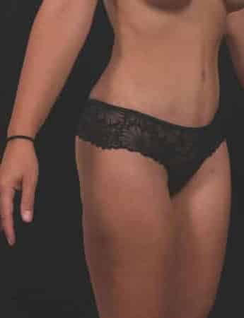 After Image: Tummy Tuck (Abdominoplasty) - right-front-oblique