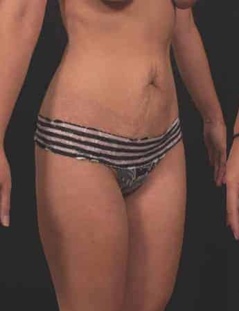 Before Image: Tummy Tuck (Abdominoplasty) - right-front-oblique