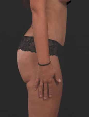 After Image: Tummy Tuck (Abdominoplasty) - right-side