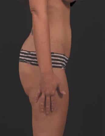Before Image: Tummy Tuck (Abdominoplasty) - right-side