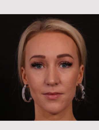 After Image: Rhinoplasty - front