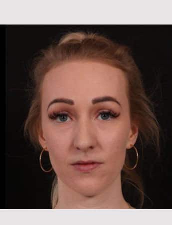 Before Image: Rhinoplasty - front