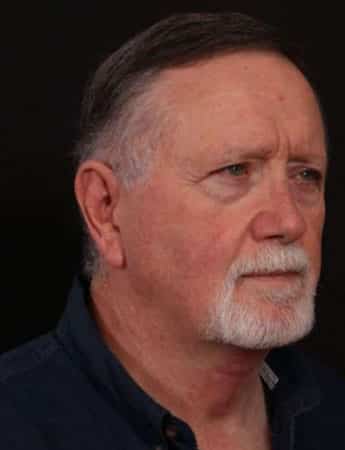 After Image: Neck Lift - right-front-oblique