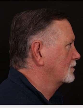 After Image: Neck Lift - right-side