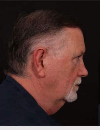 Before Image: Neck Lift - right-side