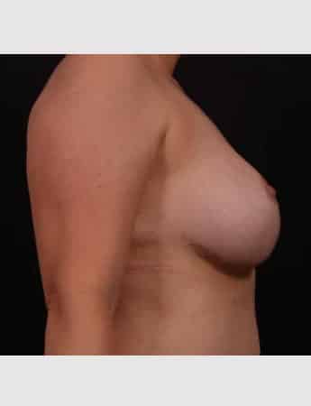 After Image: Mastopexy (Breast Lift) - right-side