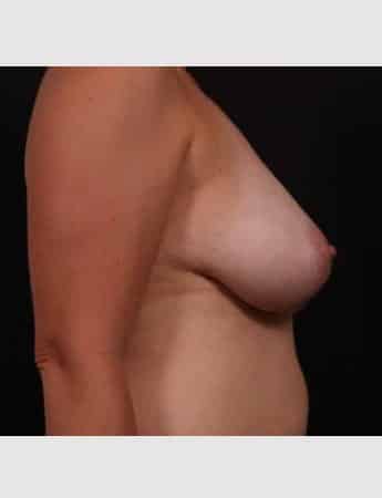 Before Image: Mastopexy (Breast Lift) - right-side