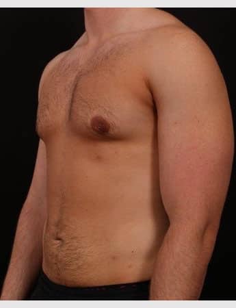 After Image: Male Gynecomastia and Liposuction - left-front-oblique
