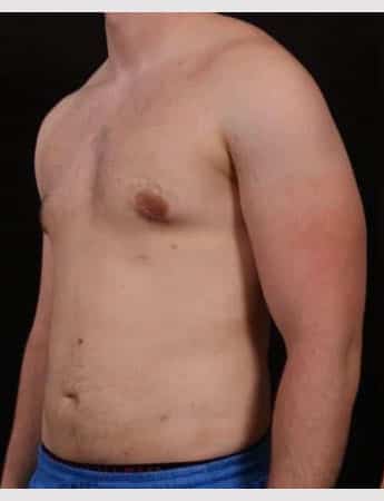 Before Image: Male Gynecomastia and Liposuction - left-front-oblique